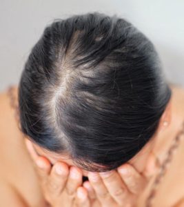 alopecia žena s černými vlasy