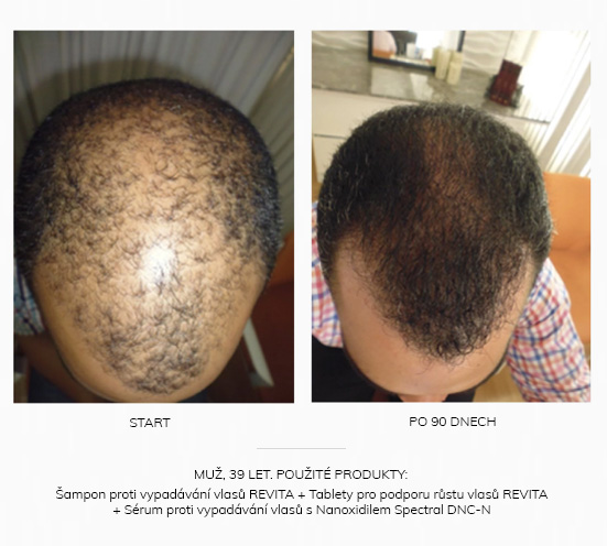 Vlasy před a po (užívání vitamínů na vlasy)
