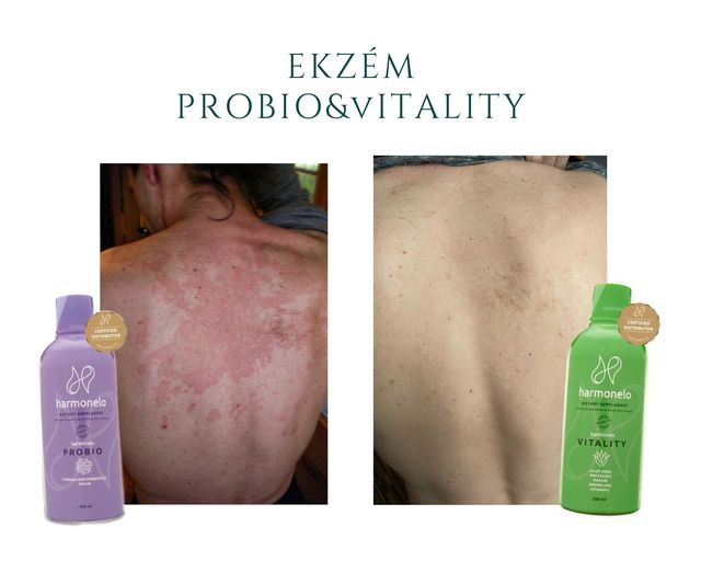 Ekzém před a po (Vitality + Probio)